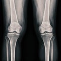 Film x-ray  both knee joint  AP view showing normal knee joint Royalty Free Stock Photo