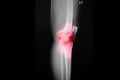 Film x-ray both knee of osteoarthritis knee patient and artificial joint. Royalty Free Stock Photo