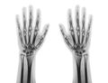 Film x-ray of both normal human hands . front view