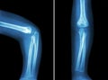 Film x-ray of child's elbow ( normal child's elbow ) ( Side and front view , Lateral and Anterior - Posterior view ) ( 2 positio