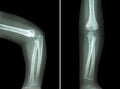 Film x-ray of child's elbow ( normal child's elbow ) ( Side and front view , Lateral and Anterior - Posterior view ) ( 2 positio