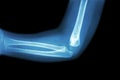 Film x-ray of child's elbow ( normal child's elbow ) ( Side view , Lateral ) Royalty Free Stock Photo