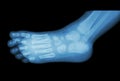 Film x-ray of child's foot ( side view ) ( lateral )