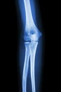 Film x-ray elbow AP : show normal human's elbow Royalty Free Stock Photo