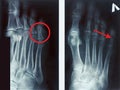 Film x-ray fracture proximal phalange at fifth toe Royalty Free Stock Photo