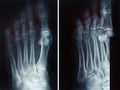 Film x-ray fracture proximal phalange at fifth toe
