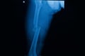 Film x-ray fracture right femur Royalty Free Stock Photo