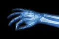 Film x-ray hand of child ( oblique view ) Royalty Free Stock Photo