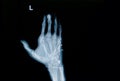 Film x-ray of hand fracture : show fracture metacarpal bone