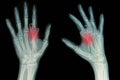 Film x-ray of hand fracture
