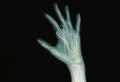 Film x-ray of hand fracture