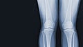 X-ray of human both knee standing views normal joints and ligaments Medical image concept Royalty Free Stock Photo