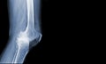 x-ray of human knee severe Osteoarthritis of the Knee normal ligaments Medical image concept Royalty Free Stock Photo