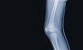 X-ray of human knee showing closed fracture,right distal femur , normal joints and ligaments Medical image concept Royalty Free Stock Photo