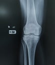 Film x-ray human\'s knee joints