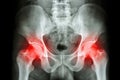 Film x-ray human's pelvis and arthritis at both hip joint (Gout , Rheumatoid) Royalty Free Stock Photo