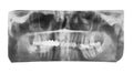 Film with X-ray image of jaws with dental crown