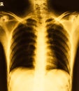 Film X-ray image of rib Royalty Free Stock Photo