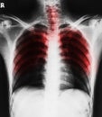 Film X-ray image of rib Royalty Free Stock Photo