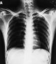 Film X-ray image of rib Royalty Free Stock Photo