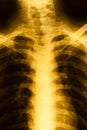 Film X-ray image of rib Royalty Free Stock Photo