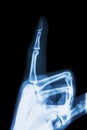 Film x-ray index finger and hand ( point a finger ) Royalty Free Stock Photo