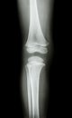 Film x-ray knee AP(antero-posterior) of child Royalty Free Stock Photo