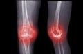 film x-ray  knee AP and lateral view of osteoarthritis knee patient and artificial joint Royalty Free Stock Photo