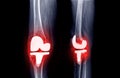 film x-ray  knee AP and lateral view of osteoarthritis knee patient and artificial joint with knee replacement Royalty Free Stock Photo