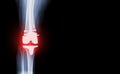 film x-ray  knee AP  view of osteoarthritis knee patient and artificial joint with Knee Replacement Royalty Free Stock Photo