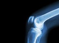 Film x-ray knee joint with arthritis ( Gout , Rheumatoid arthritis , Septic arthritis , Osteoarthritis knee ) and blank area at le Royalty Free Stock Photo