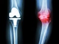 Film x-ray knee of osteoarthritis knee patient and artificial joint Royalty Free Stock Photo