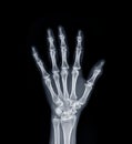 Film x-ray Left  Hand  AP view show  human's hands isolated  on black background Royalty Free Stock Photo