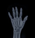 Film x-ray Left  Hand  AP view show  human's hands isolated  on black background Royalty Free Stock Photo