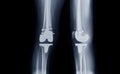 film x-ray Left knee AP and lateral  view of osteoarthritis knee patient and artificial joint with Knee Replacement Royalty Free Stock Photo