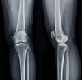 Film x-ray of Left knee joint AP and Lateral view for diagnosis knee pain from osteoarthritis knee and fracture