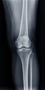 Film x-ray of Left knee joint AP view for diagnosis knee pain from osteoarthritis knee and fracture