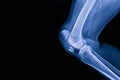 A film x-ray of left knee lateral view shown fracture of knee cap(patella) bone.