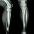 Film x-ray leg & knee AP/lateral Royalty Free Stock Photo