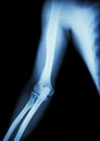 Film x-ray of normal arm , elbow and forearm Royalty Free Stock Photo