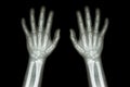 Film X-ray normal both hands of child Royalty Free Stock Photo