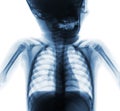 Film x-ray normal chest of baby . Upper half of body . Front view Royalty Free Stock Photo