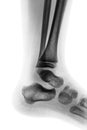 Film x-ray of normal child ankle . Lateral view