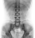 Film x-ray of normal human lumbar spine . Royalty Free Stock Photo