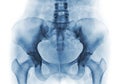 Film x-ray of normal human pelvis and hip joints Royalty Free Stock Photo