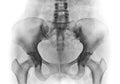 Film x-ray of normal human pelvis and hip joints