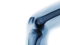 Film x-ray of normal knee joint Royalty Free Stock Photo