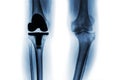 Film x-ray of osteoarthritis knee patient and artificial joint & x28; Total knee replacement & x29; . Isolated background Royalty Free Stock Photo