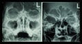 Film x-ray paranasal sinus show frontal sinus , maxillary sinus , ethmoid sinus
