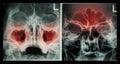 Film X-ray paranasal sinus : show sinusitis at maxillary sinus ( left image ) , frontal sinus ( right image ) Royalty Free Stock Photo